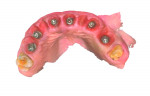 (18.) Intraoral scan demonstrating remarkable healing of the soft tissue.