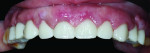 (23.) Retracted close-up maxillary view of the of final FP1 zirconia prosthesis on the day of insertion.