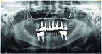 (22.) Final panoramic radiograph acquired to confirm proper seating of the final screw retained restorations.