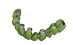 (13.) Design software view of the FP1-style provisional prosthesis.