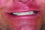 Fig 1. Pretreatment natural dentition in edge-to-edge incisal position with missing posterior teeth and lateral tongue enlargement.