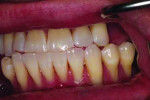 Fig 2. Pretreatment natural dentition, left lateral view.