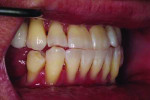 Fig 3. Pretreatment natural dentition, right lateral view.