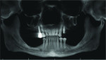 Fig 4. Panoramic radiograph showing
pretreatment bone loss and remaining dentition.