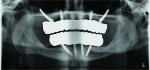 Fig 6. Panoramic radiograph demonstrating maxillary and mandibular screw-retained zirconium-opposing-zirconium
prostheses providing posterior function.