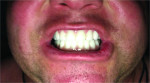 Fig 7. Initial zirconium definitive prostheses demonstrating narrow posterior tooth position in centric
occlusion.