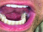 Fig 8. Lateral posterior tongue restriction was evident with zirconium screw-retained definitive prosthesis.