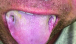 Fig 9. Lateral borders of the
tongue showing through and through bilateral penetration.