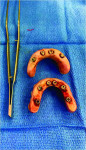 Fig 11. The prosthesis was removed surgically without the use of a driver. It was removed at the implant level with a surgical bur.