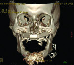 Fig 12. Vascularized fibula was grafted to the remaining maxilla after removal of the apical portion of the zygomatic implants.