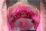 Fig 15. Maxillary abutments surrounded by
healthy mucosa.