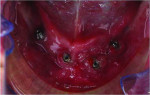 Fig 16. Four mandibular implants and abutments with healed mucosal tissue over the particulate bone and BMP bone graft.