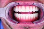 Fig 17. Provisional PMMA prostheses with widened posterior to provide adequate prosthetic space for the lateral borders of the tongue.