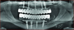 Fig 18.
Postoperative panoramic radiograph. The maxillary arch had axial implants with bicortical stabilization from the fibular bone graft. The mandibular
arch had axial and tilted implants, and bone tissue engineering was employed.