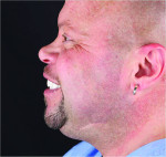 Fig 19. The definitive screw-retained fixed prostheses provided
physiologic lip and muscle support.