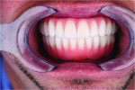 Fig 20. Retracted view of the definitive maxillary and mandibular prostheses following the completed revision
treatment.