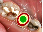 Fig 1. Central, middle, and peripheral implant positional zones are also referred to as the green (go), yellow (caution), and red (danger) zones, respectively.