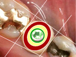 Fig 2. Optimal implant placement is in the green zone. The border of the implant’s platform is found within the central third of the tooth to be restored.