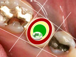 Fig 3. The yellow zone; the edge of the implant’s platform is in the “para-central” third of the tooth to be fabricated.