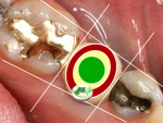 Fig 4. The red zone; the implant’s platform is found at the boundary or outside the tooth to be restored