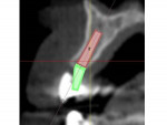 Fig 5. The term “angulation” denotes the trajectory that an implant follows as it penetrates into bone.