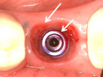 Fig 6. “Sink depth” is the distance between the gingival margin and implant platform. The coronal arrow points to the gingival margin, and the apical arrow is directed at the level of the implant platform. “Running room” is a prosthetic term that mimics sink depth.