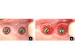 Fig 7. Left, A: Intraoral occlusal view of implant sites Nos. 2 and 3 (maxillary right second and first molars) after removal of the circular healing collars. Right, B: The same sites after the soft tissue has been nonsurgically sculpted by pressure through the use of two interim titanium cylinders and a fixed provisional resin prosthesis. Note the shape of the crevice more closely reflects the cross-sectional shape that is needed to restore these two molar teeth to proper form.