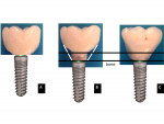 Fig 8. Left, A: Implant with non-existent running room results in an abrupt shape change between the implant and restoration. Center, B: Increased sink depth, but the failure to use running room to create a gradual emergence profile creates a tulip-shaped restoration that is difficult to clean. The lower black horizontal line represents bone level. Right, C: Disparity between the implant size and restoration contour is corrected, and a gradual emergence profile facilitates personal and professional aftercare.