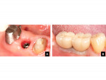 Fig 9. Left, A: Sink depth at No. 30. Right, B: Restoration of No. 30 demonstrates a transition from the 4-mm diameter implant platform to the larger cervical geometry of a mandibular first molar.