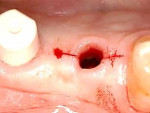 Fig 10. A gingival incision is made at site No. 28 to accommodate seating a large abutment.