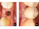 Fig 11. Left, A: At site No. 28, an implant is placed in the yellow zone. The yellow line indicates the positional zone. Right, B: A 15-degree abutment is used to laterally shift the occlusal table 1.5 mm to the buccal, thus optimizing the dimensions of the tooth.