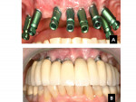 Fig 12. Top, A: In the maxilla, multiple malposed and misangulated implants were placed in the red zone. Transfer copings are shown seated on implants. Bottom, B: The case has been restored. The prosthesis required custom abutments, increased sink depths, and restoration size changes to avoid abrupt changes to tooth contours.