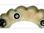 Fig 13. A malpositioned implant (mesiodistally, “embrasure implant”) is used and the prosthesis is screw-retained.