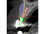 Fig 14. Intentional misangulation of an implant to avoid perforating through the buccal plate of site No. 12. The purple area on the buccal is where additional bone augmentation would be needed if the implant was placed straight into the bone.