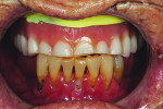 (1.) Pretreatment retracted view showing the patient’s severely worn denture and terminal lower dentition.