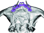 (2.) Treatment planning view showing the eference bar fixated on the anterior premaxilla.