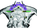 (4.) View of the planned implant locations and angles of the multi-unit abutments.