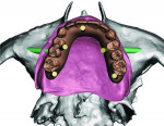 (5.) View of the planned maxillary restoration, which was designed by Farley and fabricated by Howell at the laboratory, showing the access holes for the planned implants and multi-unit abutments.