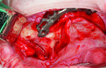 (11.) Retracted view of the preparation for the placement of the right zygomatic implant. The purchase point was created with a round diamond-coated bur.