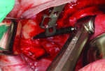 (15.) Osteotomy creation utilizing the channel to maintain the same trajectory.