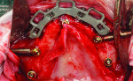 (18.) Maxillary occlusal view showing all of the placed implants, multi-unit abutments, and reference bar.