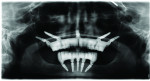 (23.) Postoperative panoramic radiograph showing the final implant placement locations and the maxillary and mandibular provisional prostheses.