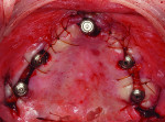 (22.) Postoperative occlusal view of the multi unit abutment healing caps and sutured soft tissue.