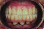 (24.) Postoperative retracted view of the maxillary and mandibular provisional prostheses