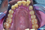 (1.) Preoperative photographs, including maxillary and mandibular occlusal views, retracted right and left lateral views with the teeth apart, and a smile photograph, respectively. Note the heavy plaque and calculus accumulation, inflamed gingival
tissues, pathological migration of teeth Nos. 7 and 10, and supra-eruption of tooth No. 15.