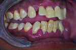 (2.) Preoperative photographs, including maxillary and mandibular occlusal views, retracted right and left lateral views
with the teeth apart, and a smile photograph, respectively. Note the heavy plaque and calculus accumulation, inflamed gingival
tissues, pathological migration of teeth Nos. 7 and 10, and supra-eruption of tooth No. 15.