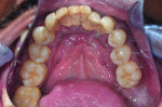 (3.) Preoperative photographs, including maxillary and mandibular occlusal views, retracted right and left lateral views
with the teeth apart, and a smile photograph, respectively. Note the heavy plaque and calculus accumulation, inflamed gingival
tissues, pathological migration of teeth Nos. 7 and 10, and supra-eruption of tooth No. 15.