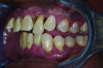 (4.) Preoperative photographs, including maxillary and mandibular occlusal views, retracted right and left lateral views
with the teeth apart, and a smile photograph, respectively. Note the heavy plaque and calculus accumulation, inflamed gingival
tissues, pathological migration of teeth Nos. 7 and 10, and supra-eruption of tooth No. 15.