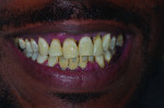 (5.) Preoperative photographs, including maxillary and mandibular occlusal views, retracted right and left lateral views
with the teeth apart, and a smile photograph, respectively. Note the heavy plaque and calculus accumulation, inflamed gingival
tissues, pathological migration of teeth Nos. 7 and 10, and supra-eruption of tooth No. 15.