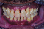 (7.) Retracted frontal, maxillary occlusal, and mandibular occlusal photographs, respectively, acquired after the performance of scaling and root planing and the extraction of teeth Nos. 1, 2, 15, 16, 17, 31, and 32.